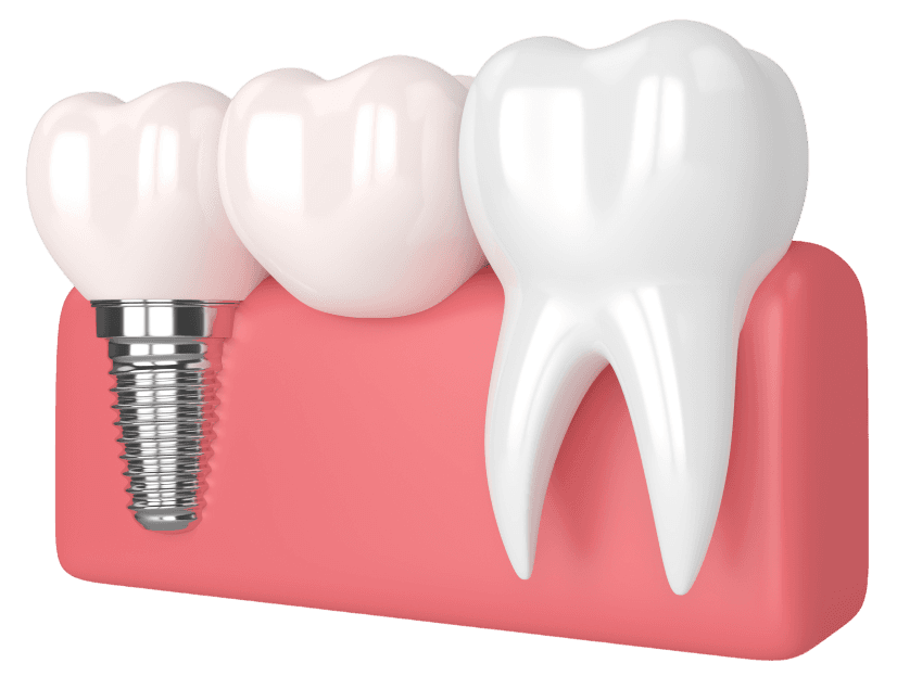 single implant